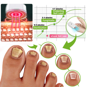 Laserové zařízení pro léčbu plísní nehtů Furzero™ Max Plus