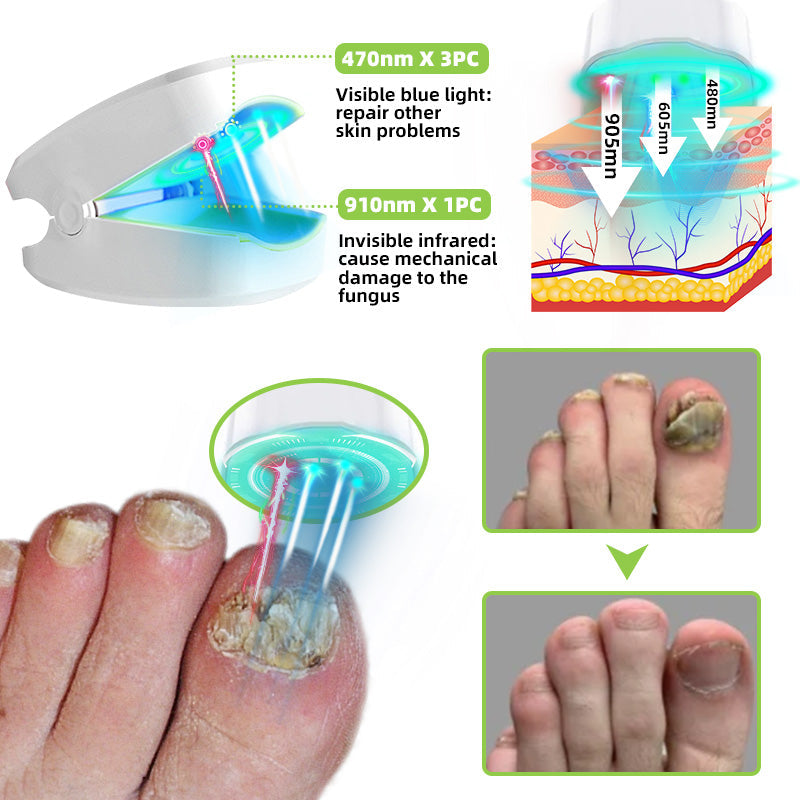 Laserové zařízení pro léčbu plísní nehtů Furzero™ Max Plus